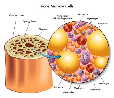 Bone Marrow Biopsy by OrangeCountySurgeons